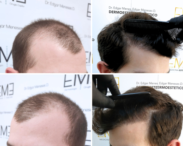 Antes (2)