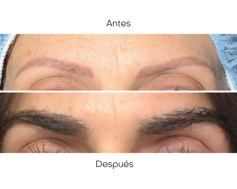 Antes (4)